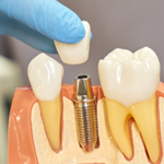 Imagen de imagen destacada - Implantes dentales