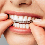 Imagen de imagen destacada - Invisalign